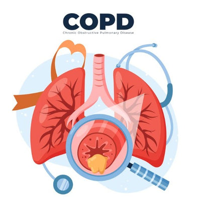 Chronic Obstructive Pulmonary Disease (COPD)